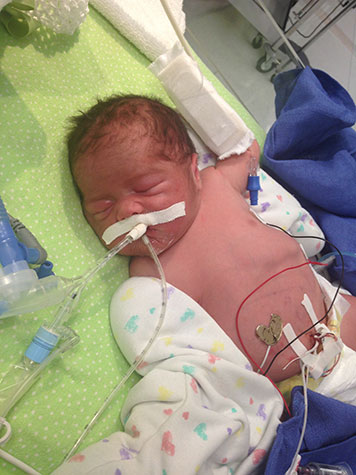 bebe-enfermedad-sindrome-de-berdon-mmhis-megavejiga-microcolon-rare-desease-hipoperistalsis