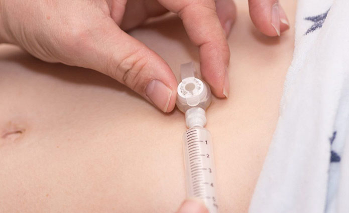 sindrome-berdon-mmihs-girl-niña-megavejiga-microcolon-hipoperistalsis-gastrointestinal-gtube-sonda-gastrica-feeding-tube